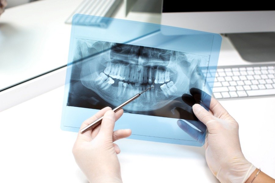Digital Dental X-Rays for Diagnosis